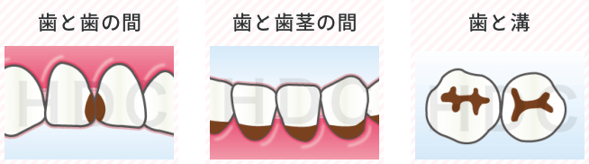 歯と歯の間・歯と歯茎の間・歯と溝