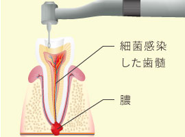 細菌感染した歯髄、膿