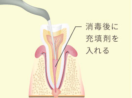 消毒後に充填剤を入れる