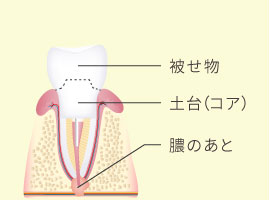 被せ物、土台、膿のあと