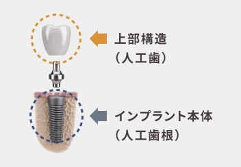 インプラントの構造