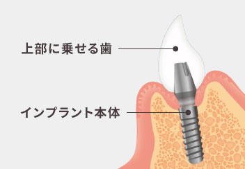 上部に乗せる歯、インプラント本体