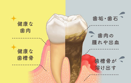 健康な歯肉、健康な歯槽骨／歯垢・歯石、歯肉の腫れや出血、歯槽骨が溶け出す