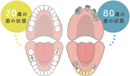 20歳の歯の状態・80歳の歯の状態