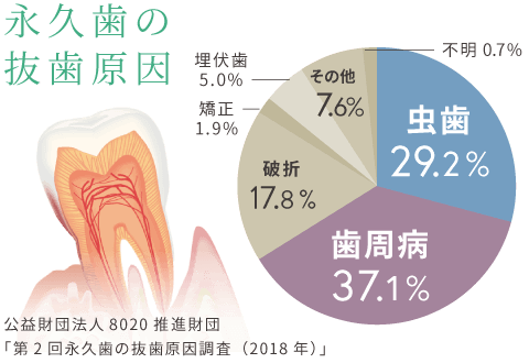 永久歯の抜歯原因